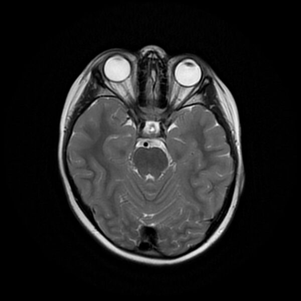 File:Adamantinomatous craniopharyngioma (Radiopaedia 77407-89529 Axial T2 9).jpg