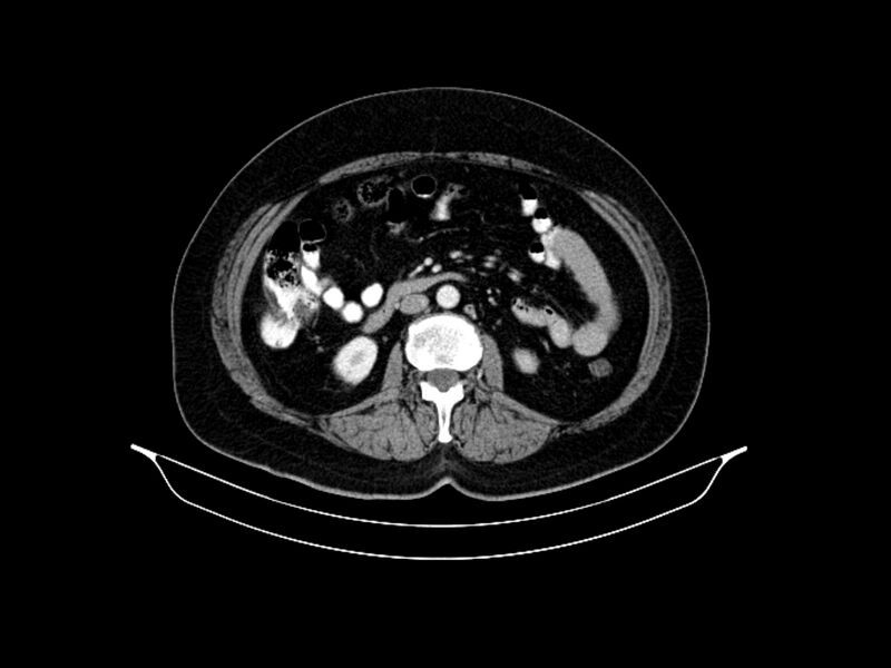 File:Adenocarcinoma of pancreas with hepatic metastasis (Radiopaedia 64332-73122 Axial C+ portal venous phase 51).jpg