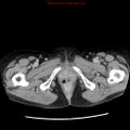 Adenocarcinoma of the colon (Radiopaedia 8191-9039 Axial renal excretory phase 66).jpg