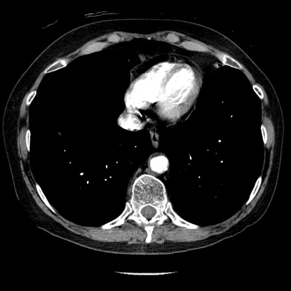 File:Adenocarcinoma of the lung (Radiopaedia 41015-43755 Axial C+ portal venous phase 92).jpg