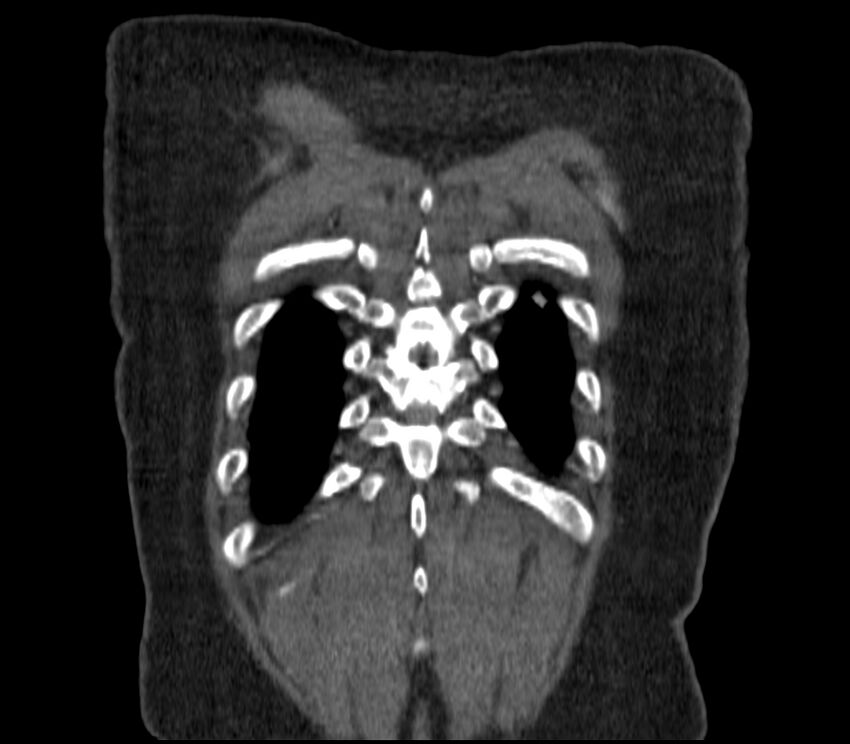 Adenocarcinoma of the lung (Radiopaedia 44205-47803 Coronal C+ portal venous phase 92).jpg