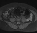 Adenomyosis - ovarian endometriomas (Radiopaedia 67031-76350 Axial T1 fat sat 2).jpg