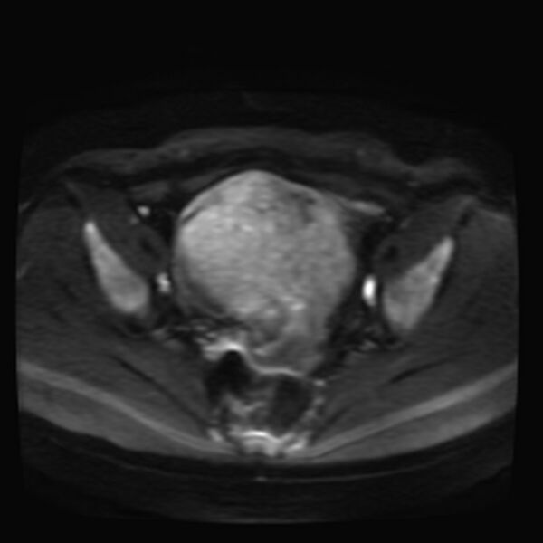 File:Adenomyosis on MRI (Radiopaedia 29328-29780 Axial DWI 7).jpg