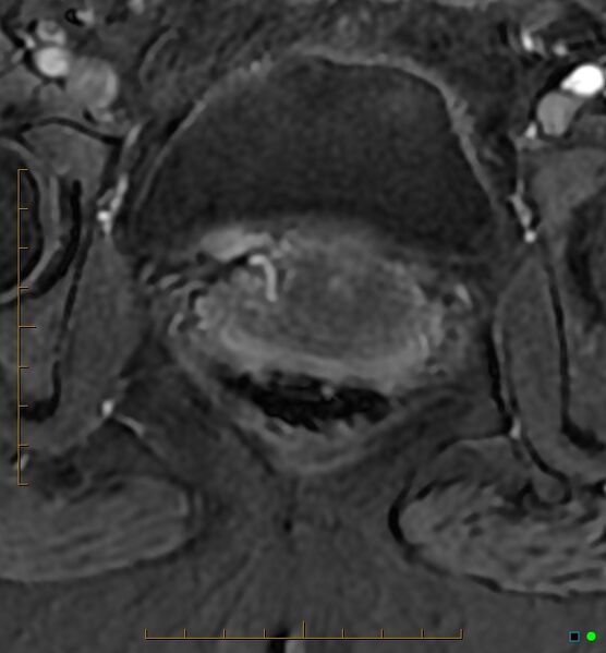 File:Adenomyosis uterus with hematometra (Radiopaedia 45779-50011 Axial T1 C+ fat sat 55).jpg