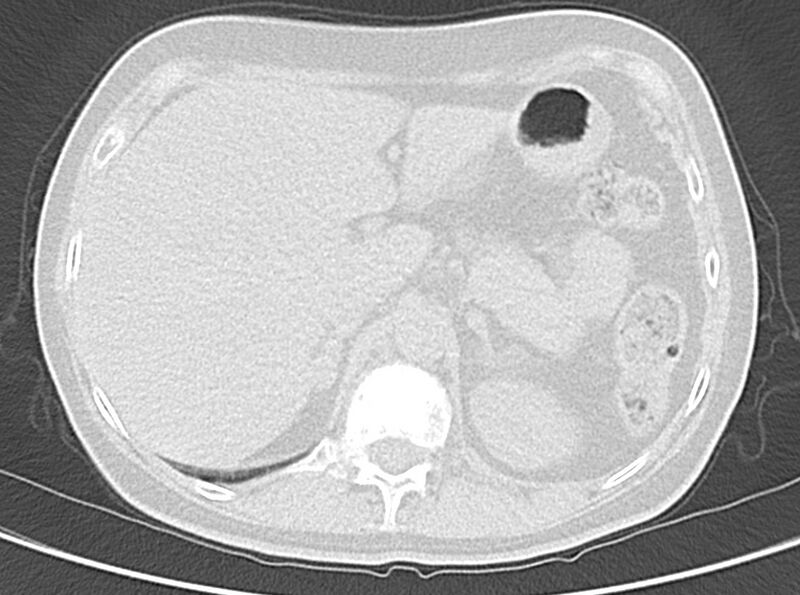File:Adenosquamous lung carcinoma (Radiopaedia 22035-22030 lung window 59).jpg