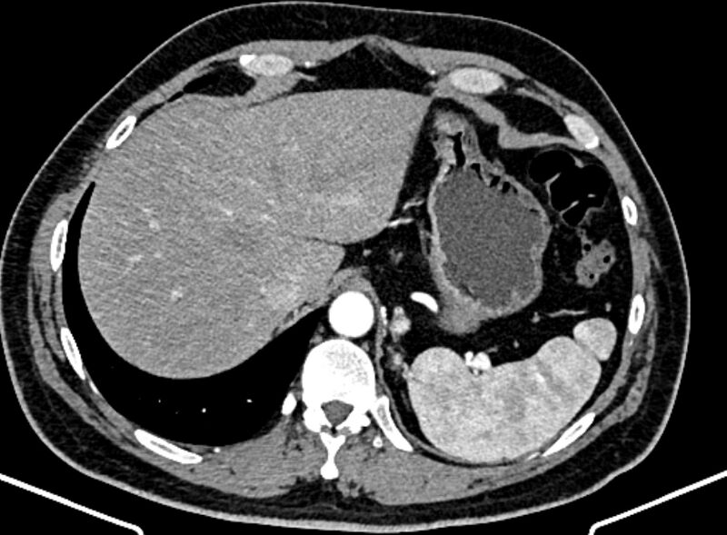 File:Adrenal metastases (Radiopaedia 73082-83791 Axial C+ arterial phase 28).jpg