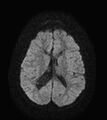 Aicardi syndrome (Radiopaedia 66029-75205 Axial DWI 14).jpg