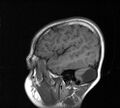 Aicardi syndrome (Radiopaedia 66029-75205 Sagittal T1 21).jpg