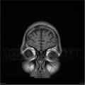 Amnestic syndrome secondary to hypoxic brain injury (Radiopaedia 24743-25004 B 24).jpg