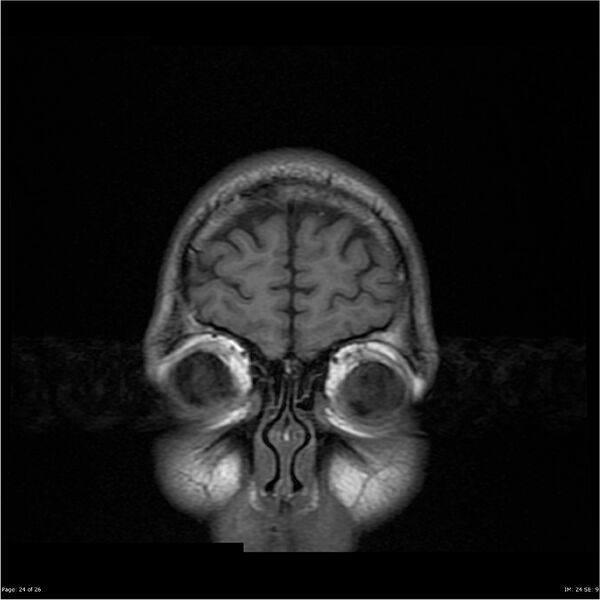 File:Amnestic syndrome secondary to hypoxic brain injury (Radiopaedia 24743-25004 B 24).jpg