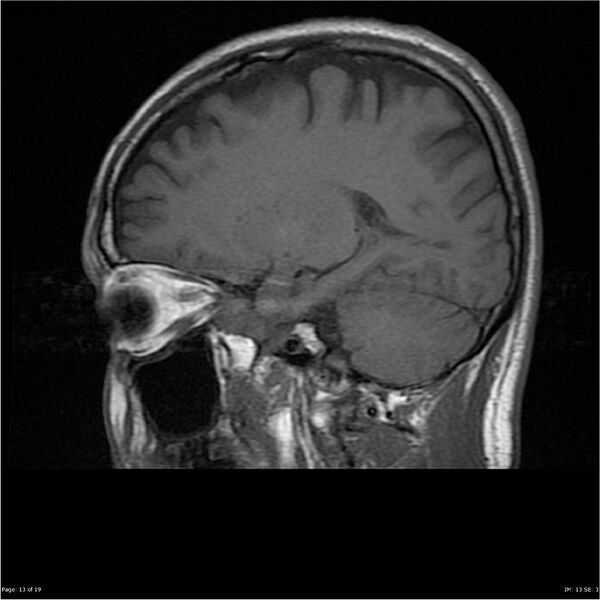 File:Amnestic syndrome secondary to hypoxic brain injury (Radiopaedia 24743-25004 T1 13).jpg