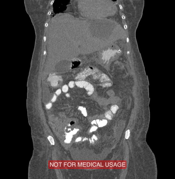File:Amoebic enterocolitis with liver abscess (Radiopaedia 35100-36609 B 50).jpg
