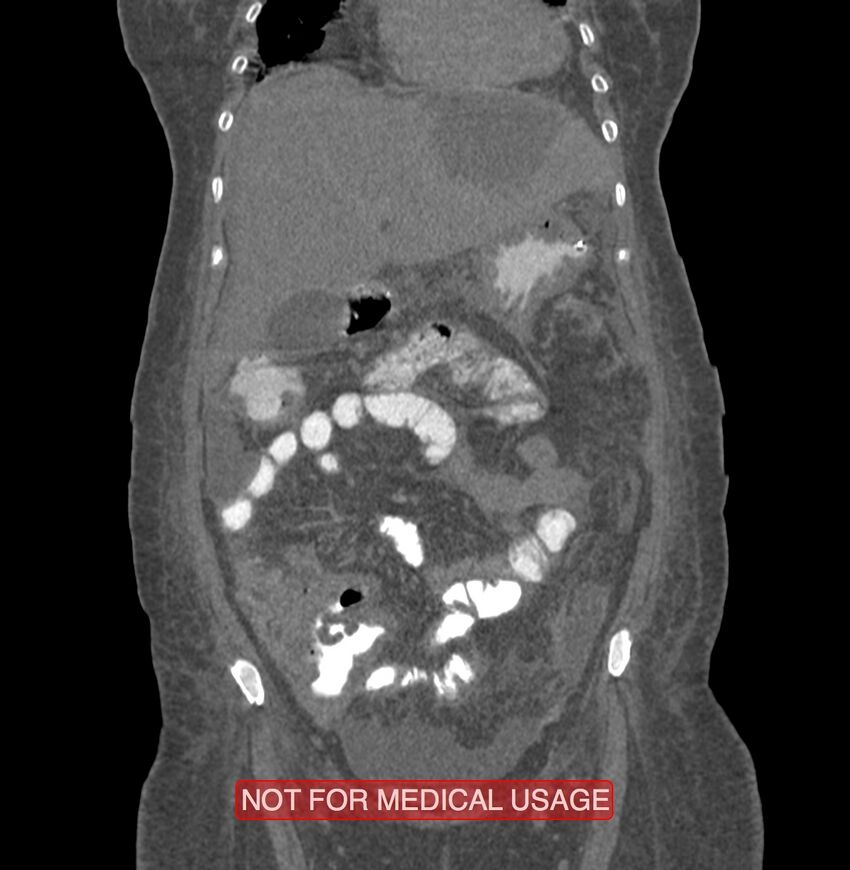 Amoebic enterocolitis with liver abscess (Radiopaedia 35100-36609 B 50).jpg