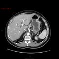Ampullary carcinoma (Radiopaedia 56396-63056 B 22).jpg
