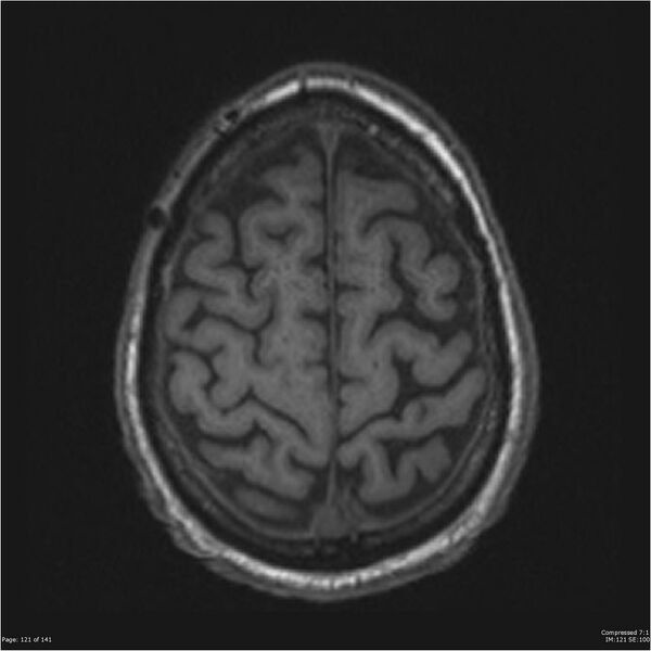 File:Anaplastic meningioma with recurrence (Radiopaedia 34452-35788 Axial T1 119).jpg