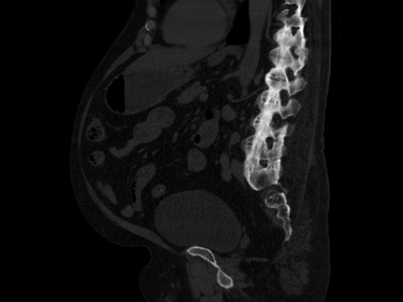 File:Ankylosing spondylitis (Radiopaedia 44609-48357 Sagittal bone window 63).jpg