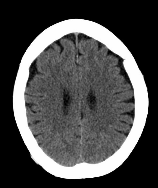 File:Anomalous intracranial venous drainage (Radiopaedia 28161-28418 Axial 34).png