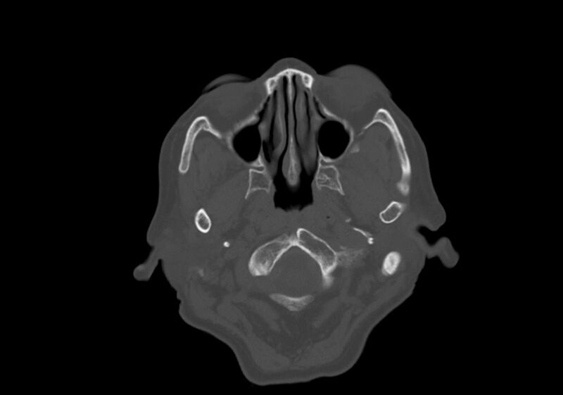 File:Anomalous intracranial venous drainage (Radiopaedia 28161-28418 Axial bone window 1).jpg