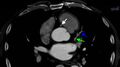 Anomalous left coronary artery- prepulmonic course (Radiopaedia 29253-29667 A 8).JPG