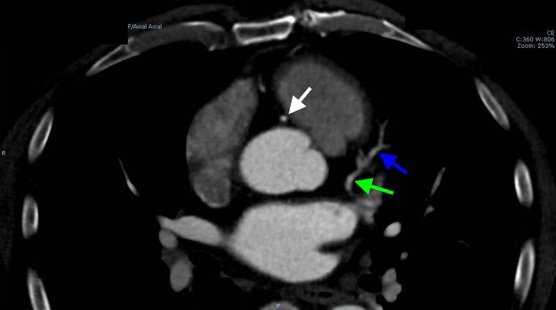 File:Anomalous left coronary artery- prepulmonic course (Radiopaedia 29253-29667 A 8).JPG