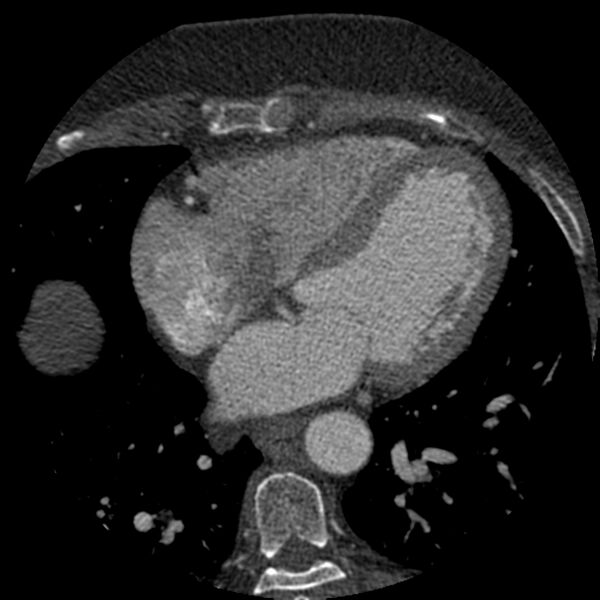 File:Anomalous origin of left circumflex artery from right coronary sinus (Radiopaedia 72563-83117 B 92).jpg