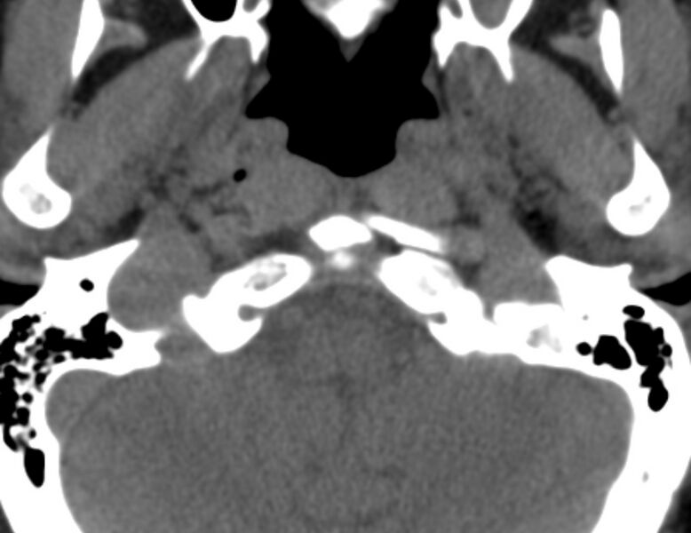 File:Anterior cervical postdiscectomy arthrodesis (Radiopaedia 32678-33646 Axial non-contrast 5).jpg