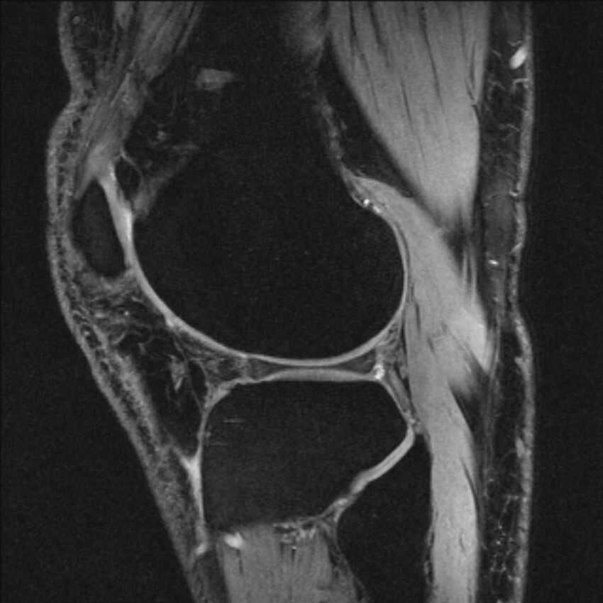 Anterior cruciate ligament mucoid degeneration (Radiopaedia 68400-77933 Sagittal 14).jpg