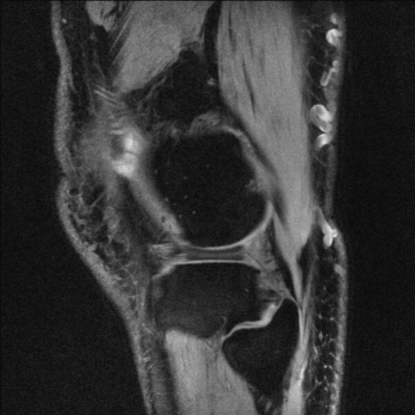 File:Anterior cruciate ligament mucoid degeneration (Radiopaedia 68400-77933 Sagittal 7).jpg