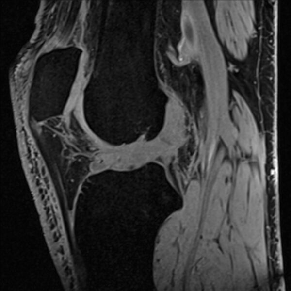 File:Anterior cruciate ligament tear - ramp lesion (Radiopaedia 71883-82322 Sagittal T1 vibe 68).jpg