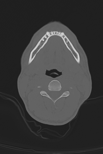 File:Anterior nasal spine fracture (Radiopaedia 46138-50494 Axial bone window 72).png