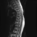 Anterior spinal artery syndrome (Radiopaedia 46335-50750 C 7).png