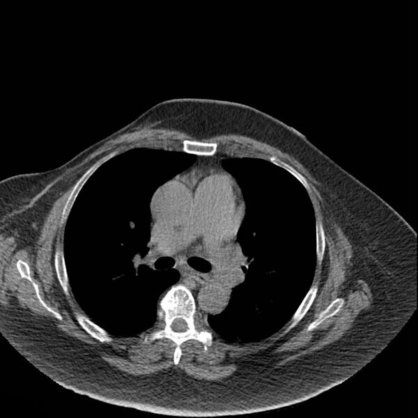 File:Aortic arch false aneurysm (Radiopaedia 14667-14587 Axial non-contrast 23).jpg