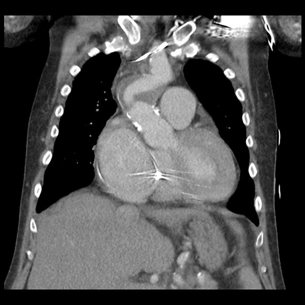 File:Aortic arch graft infection (FDG PET-CT) (Radiopaedia 71975-82437 Coronal 23).jpg