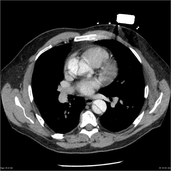 File:Aortic dissection- Stanford A (Radiopaedia 37759-39664 A 35).jpg