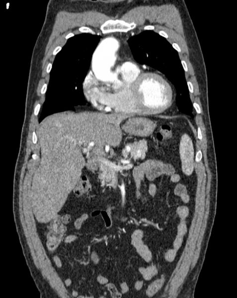 File:Aortic dissection (Radiopaedia 44411-48061 A 5).jpg
