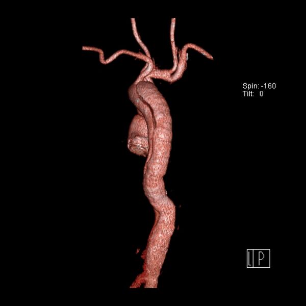 File:Aortic dissection - De Bakey type III - Stanford B (Radiopaedia 21903-21882 3D C+ arterial phase 11).jpg