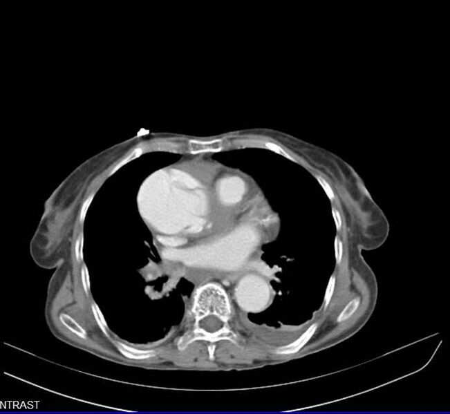 File:Aortic dissection - Stanford type A (Radiopaedia 20760-20675 C 3).jpg