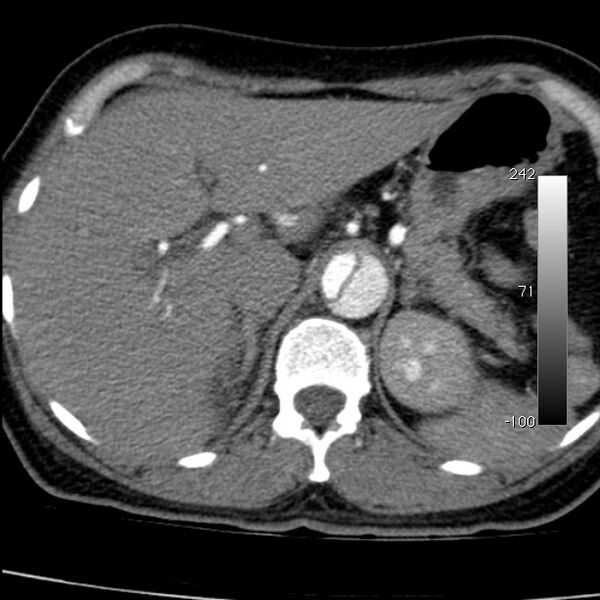 File:Aortic dissection - Stanford type A (Radiopaedia 29247-29659 A 77).jpg