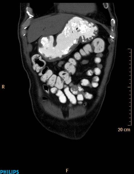 File:Appendiceal mucocoele (Radiopaedia 29449-29917 E 53).jpg
