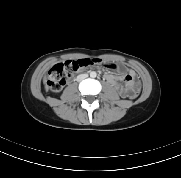 File:Appendicitis and incidental bicornuate uterus (Radiopaedia 22833-22853 B 23).jpg
