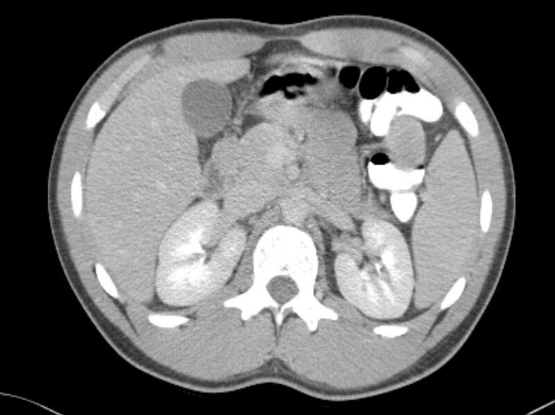 File:Appendicitis and incidental foregut duplication cyst (Radiopaedia 52962-58916 A 10).jpg