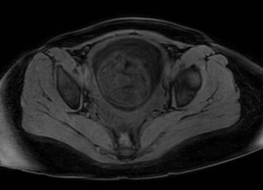 Appendicitis in gravida (MRI) (Radiopaedia 89433-106395 Axial DIXON 129).jpg