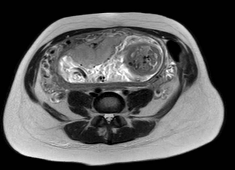 File:Appendicitis in gravida (MRI) (Radiopaedia 89433-106395 Axial T2 44).jpg
