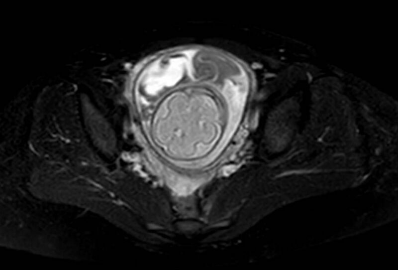 File:Appendicitis in gravida (MRI) (Radiopaedia 89433-106395 Axial T2 SPAIR 65).jpg