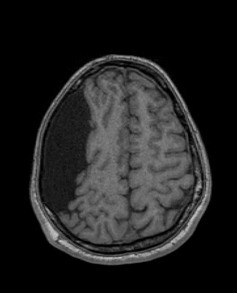 File:Arachnoid cyst- extremely large (Radiopaedia 68741-78451 Axial T1 61).jpg