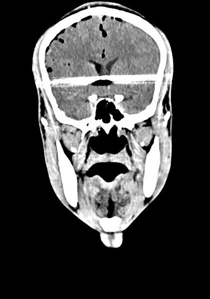 File:Arrow injury to the brain (Radiopaedia 72101-82607 Coronal non-contrast 33).jpg