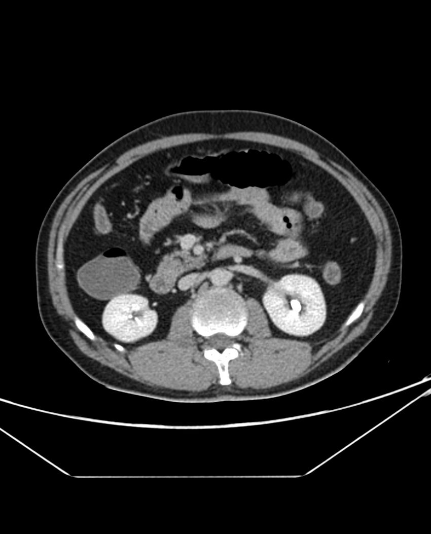 Arterial occlusive mesenteric ischemia (Radiopaedia 84641-100054 A 49).jpg