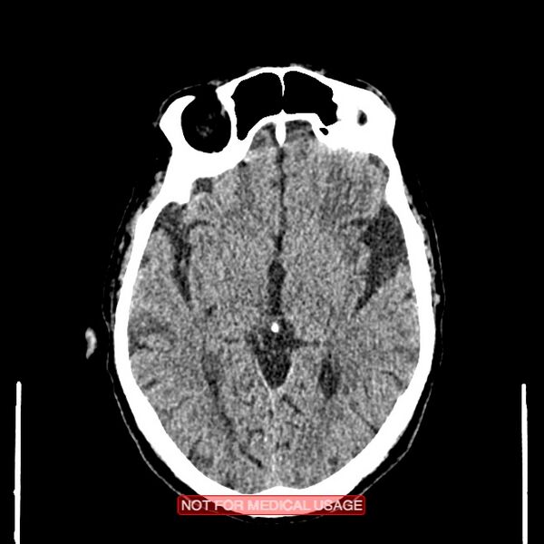 File:Artery of Percheron infarction (Radiopaedia 28679-28967 Axial non-contrast 57).jpg
