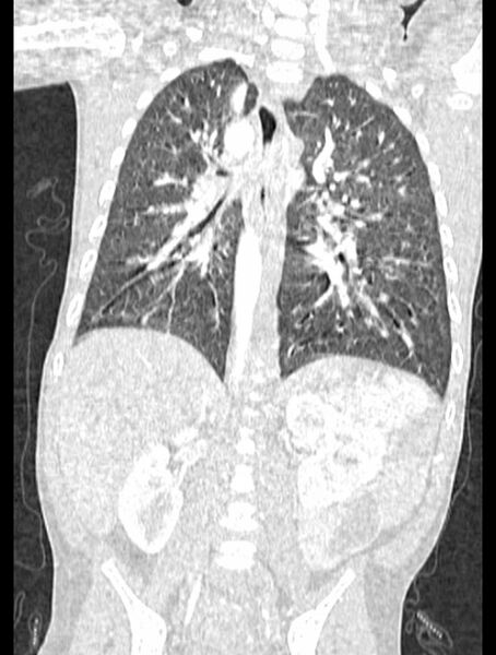 File:Asplenia syndrome (Radiopaedia 73083-83792 Coronal lung window 91).jpg
