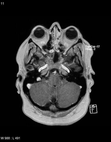 File:Astroblastoma (Radiopaedia 39792-42217 Axial T1 C+ 10).jpg